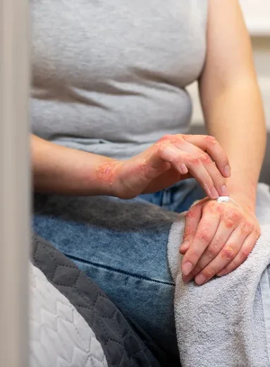 Person applying soothing cream to skin rashes, common signs of lupus.