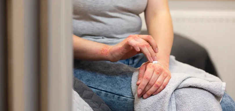 Person applying soothing cream to skin rashes, common signs of lupus.