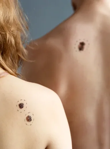 Common markings on skin to help identify 3 types of skin cancer.