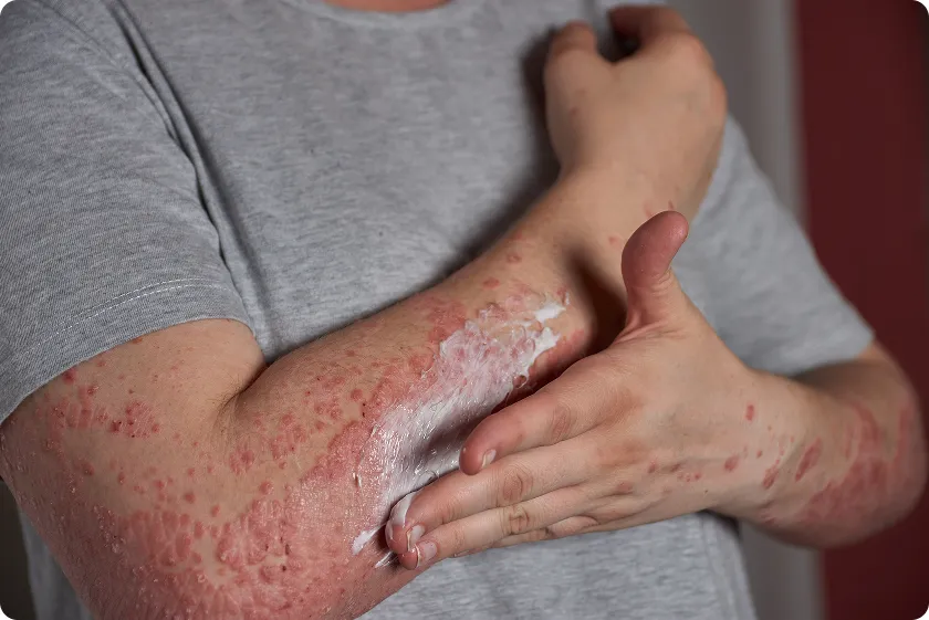 Man applying medicated ointment to skin irritation and lupus symptoms men.