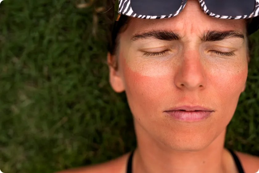 Close up of woman with butterfly facial rash, illustrating signs of lupus.
