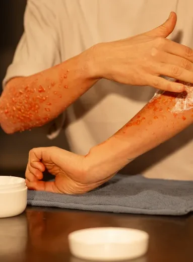 1 Applying cream to poison ivy rash pics showing inflamed arm skin irritation pictures of poison ivy