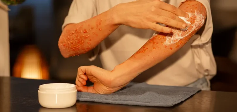 Applying cream to poison ivy rash pics showing inflamed arm skin irritation pictures of poison ivy